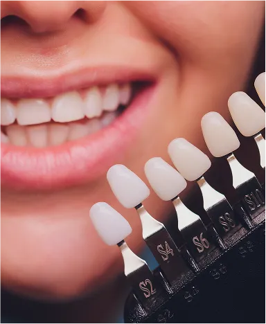 Porcelain Veneers
