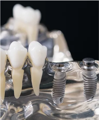 Dental Implants